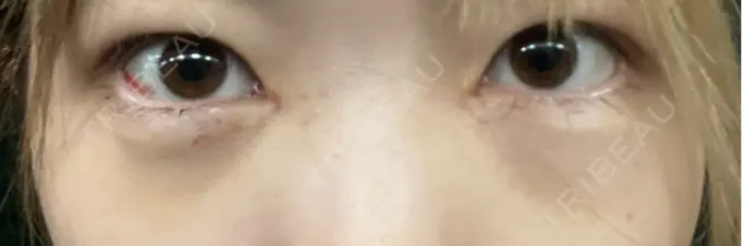 クマ治療 / ヒアルロン酸注入（目の下） BITO BEAUTY CLINIC DAY 5 メイン用