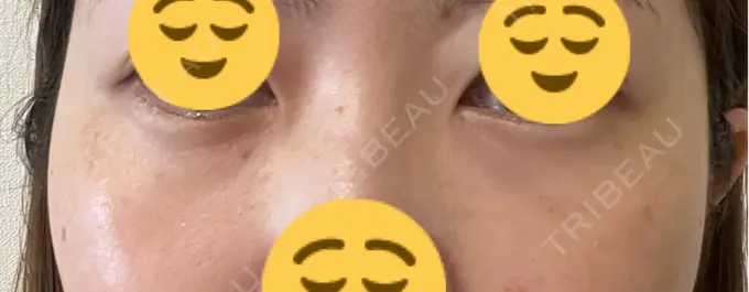 下まぶたたるみ取り / 脂肪注入（目の下） プラストクリニック DAY 14 メイン用