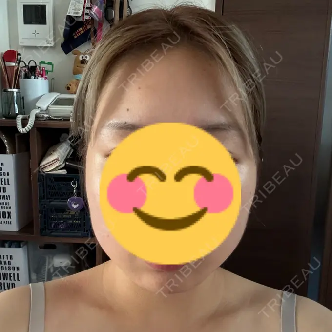 ボトックス（エラ・小顔） TCB東京中央美容外科 札幌駅前院 AFTER メイン用