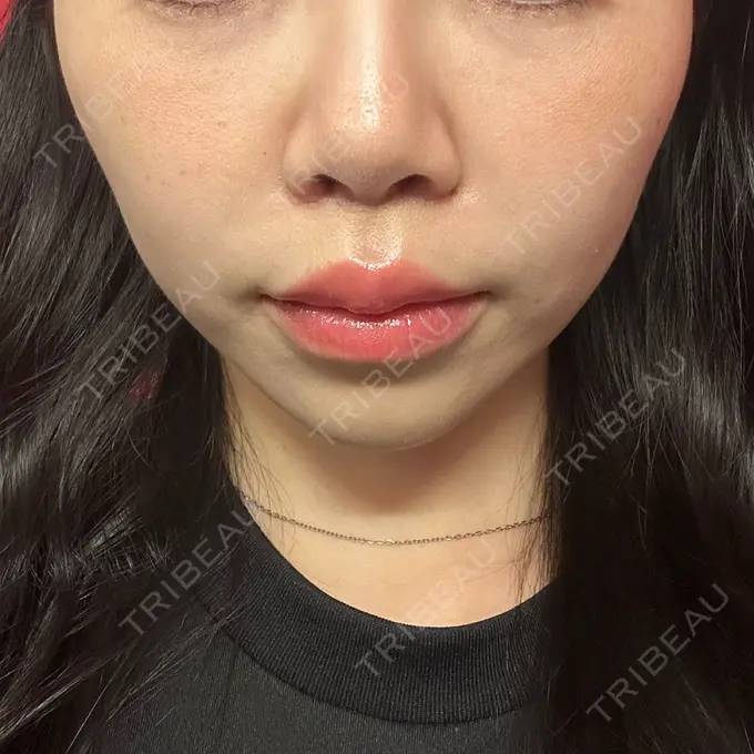 人中短縮 / ヒアルロン酸注入（目の下） / RF（高周波）たるみ治療 BITO BEAUTY CLINIC DAY 6 メイン用