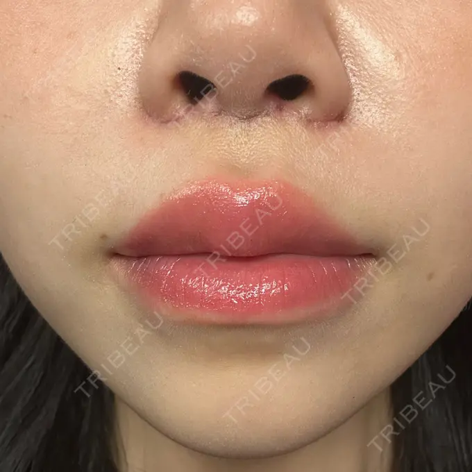 人中短縮 / ヒアルロン酸注入（目の下） / RF（高周波）たるみ治療 BITO BEAUTY CLINIC DAY 6 メイン用