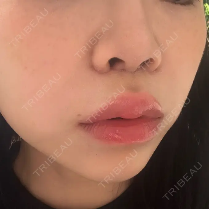 人中短縮 / ヒアルロン酸注入（目の下） / RF（高周波）たるみ治療 BITO BEAUTY CLINIC DAY 6 メイン用