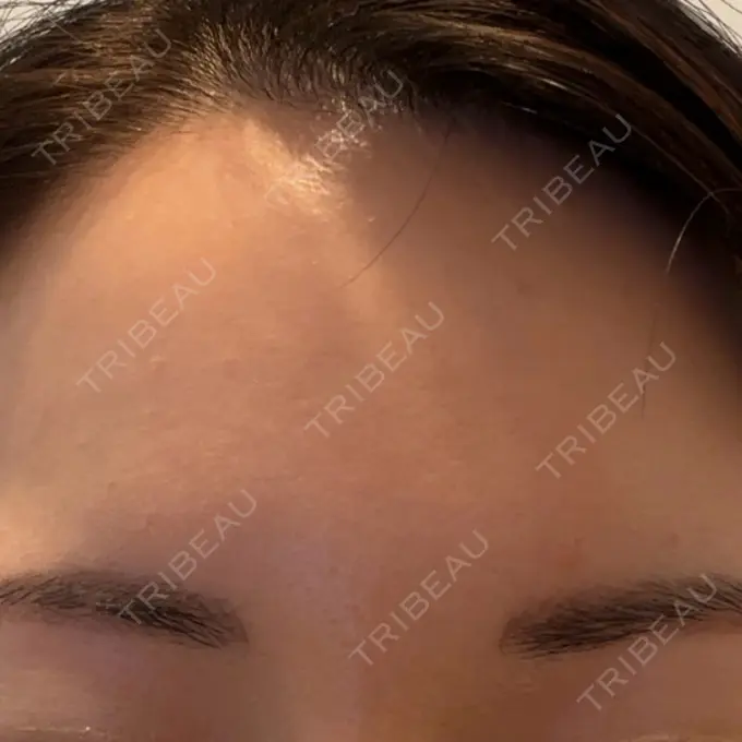 シワ取りボトックス 福岡TAクリニック DAY 14 メイン用