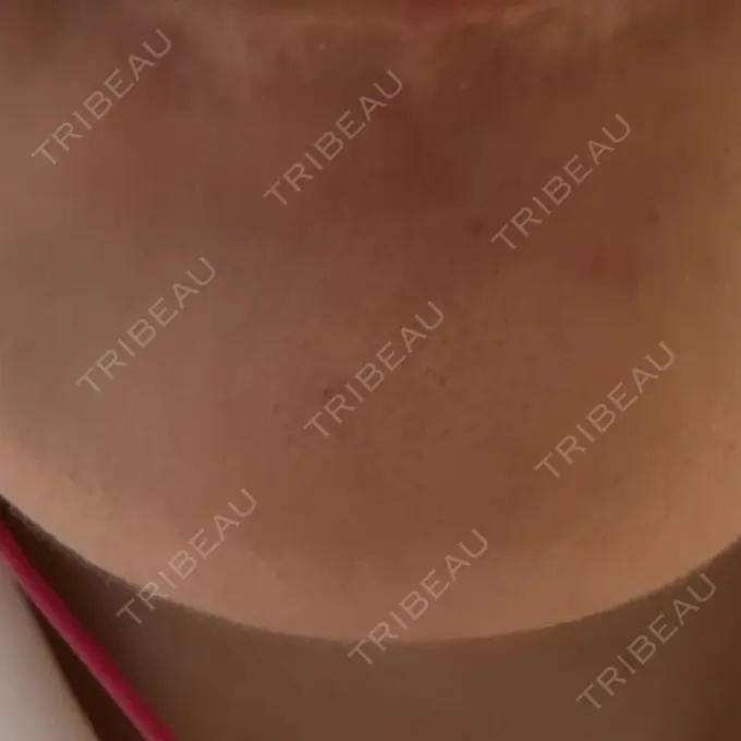 シワ取りボトックス 福岡TAクリニック DAY 14 メイン用