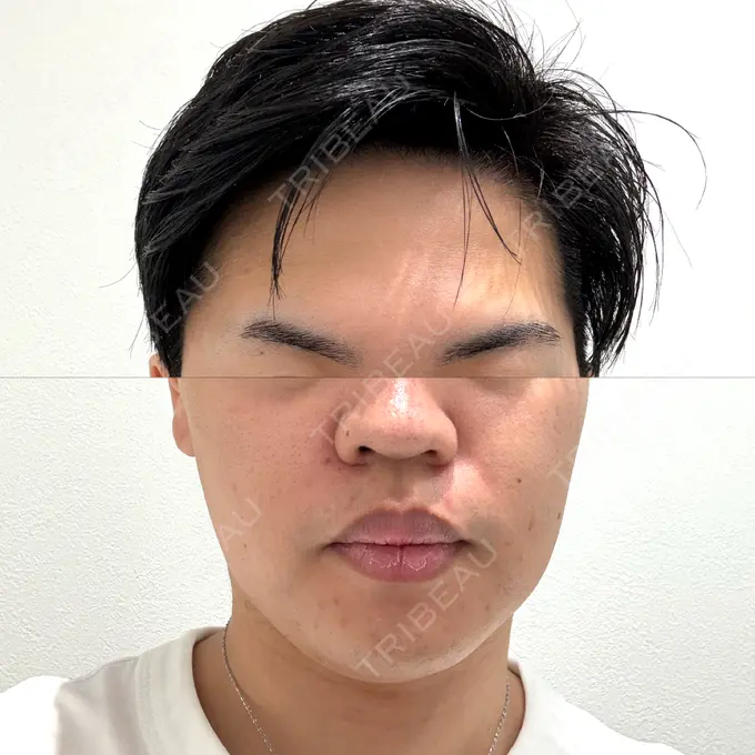 ピーリング（ニキビ・毛穴） First Clinic AFTER メイン用