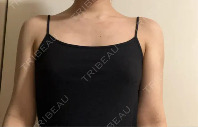 脂肪吸引（二の腕） 豊洲内科・糖尿病 / 形成・美容外科クリニック AFTER メイン用