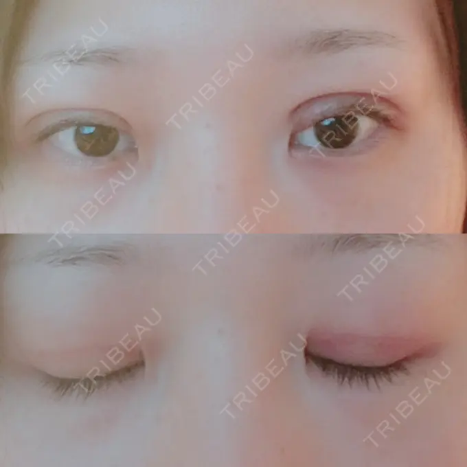 二重切開 城本クリニック 豊橋院 DAY 35 メイン用