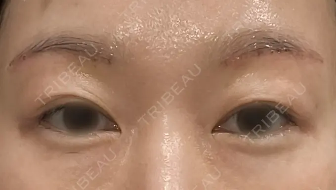 眉下切開 もとび美容外科クリニック 新宿院 DAY 6 メイン用