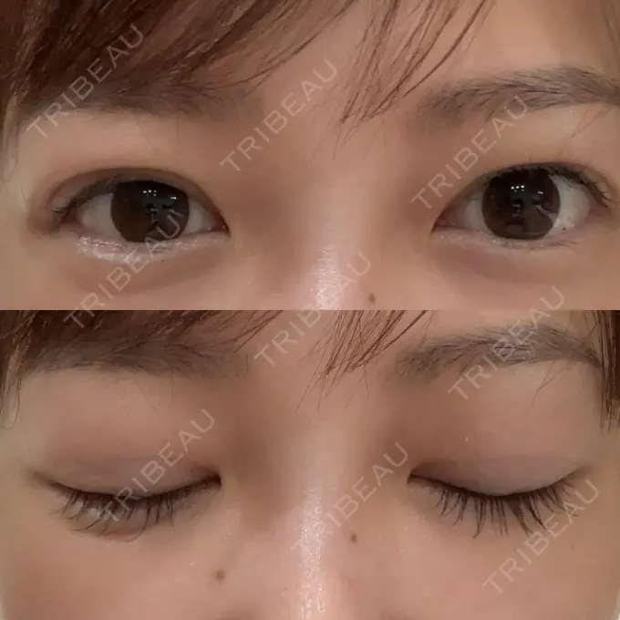 二重埋没 / 糸リフト アリエル美容クリニック 横浜院 DAY 7 メイン用