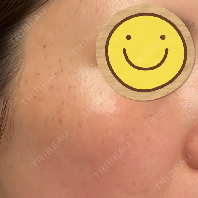 光治療（フォトフェイシャルなど） / ルメッカ Clinic K Blossom DAY 0 メイン用