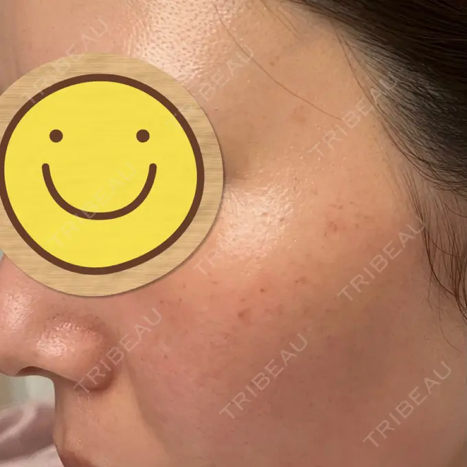 光治療（フォトフェイシャルなど） / ルメッカ Clinic K Blossom DAY 0 メイン用