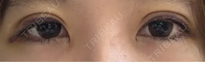 二重埋没 アリエル美容クリニック 水戸院 DAY 5 メイン用