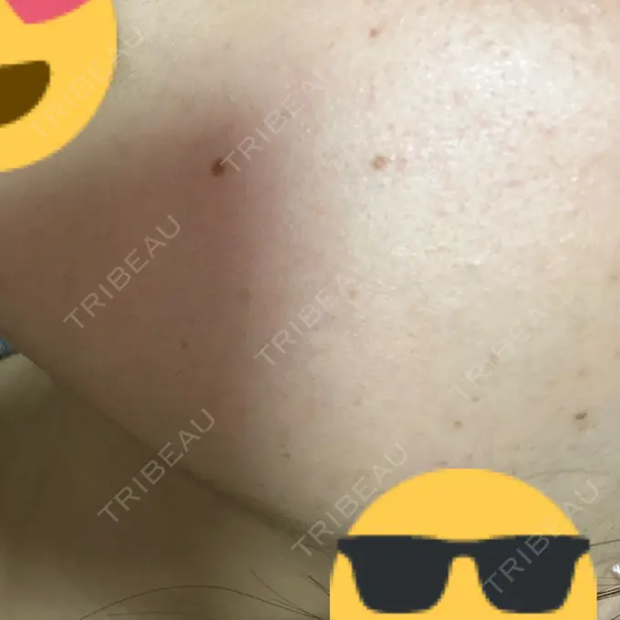 ボトックス（エラ・小顔） 共立美容外科 名古屋院 DAY 5 メイン用