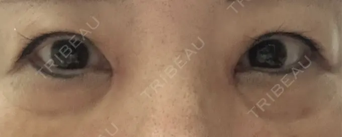 目頭切開 / 下まぶたたるみ取り eクリニック 福岡院 AFTER メイン用