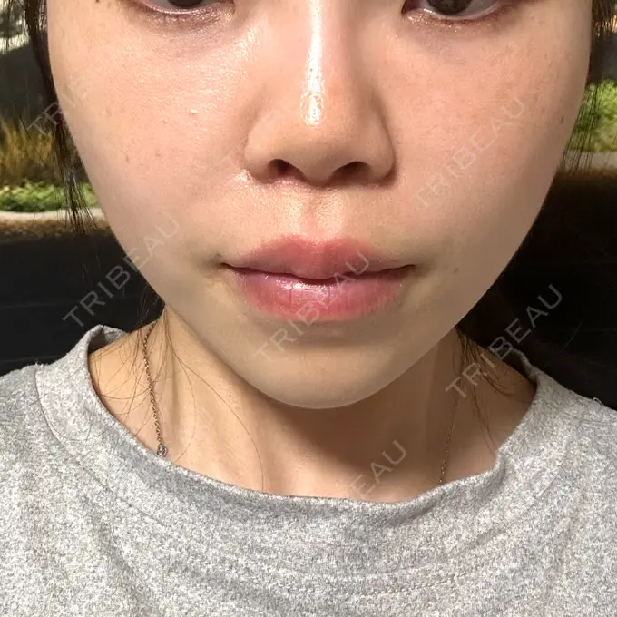 人中短縮 / ヒアルロン酸注入（目の下） / RF（高周波）たるみ治療 BITO BEAUTY CLINIC DAY 7 メイン用