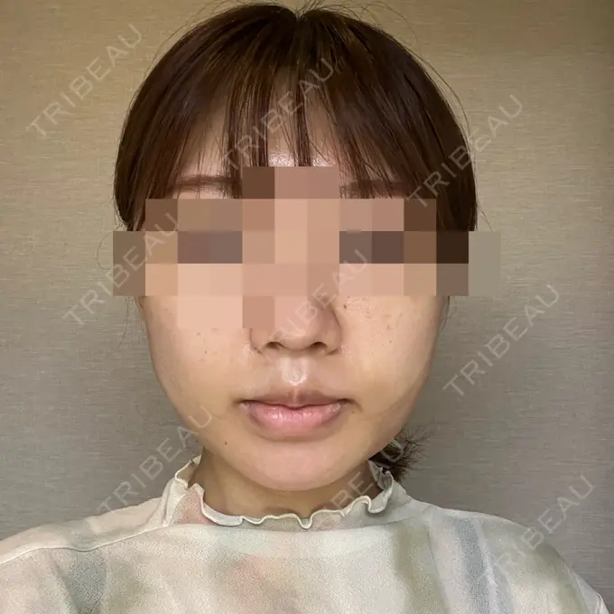 糸リフト / 脂肪吸引（顔） / 脂肪吸引注射（顔） ziz CLINIC DAY 1 メイン用