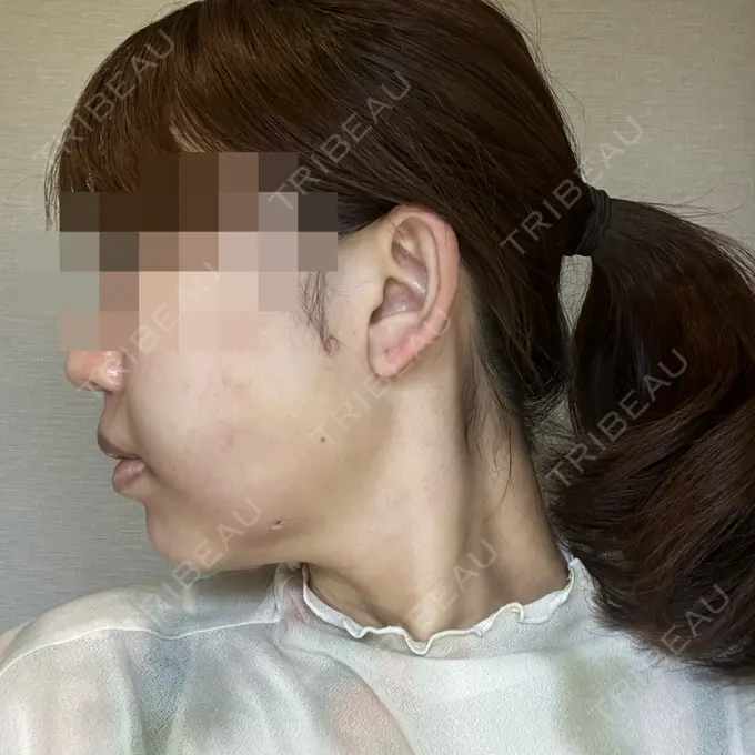 糸リフト / 脂肪吸引（顔） / 脂肪吸引注射（顔） ziz CLINIC DAY 1 メイン用