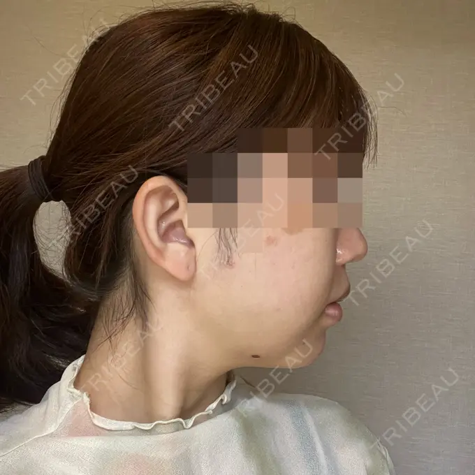 糸リフト / 脂肪吸引（顔） / 脂肪吸引注射（顔） ziz CLINIC DAY 1 メイン用