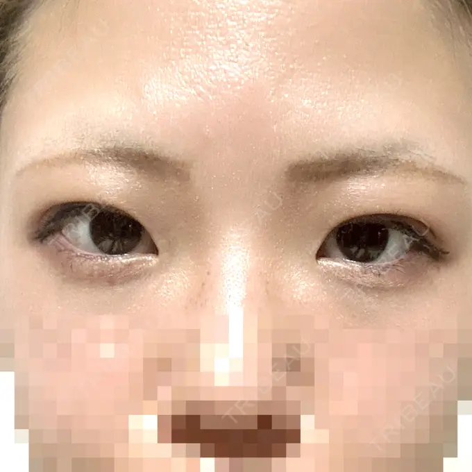 二重埋没 アリエル美容クリニック 横浜院 AFTER メイン用