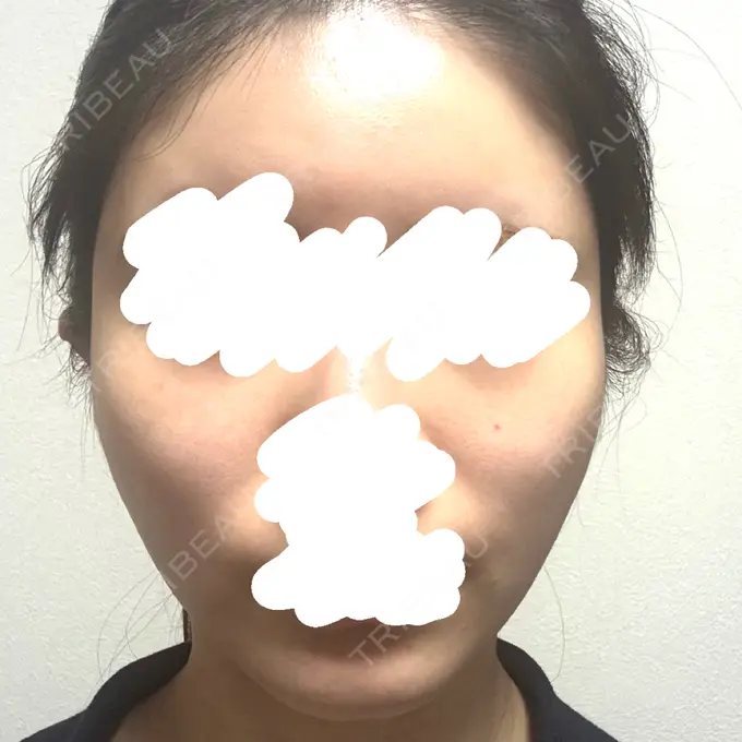 糸リフト / バッカルファット除去 / 脂肪吸引（顔） / 脂肪吸引（二の腕） / ジョールファット除去 / 脂肪吸引（肩） / 脂肪注入（輪郭） First Clinic DAY 14 メイン用