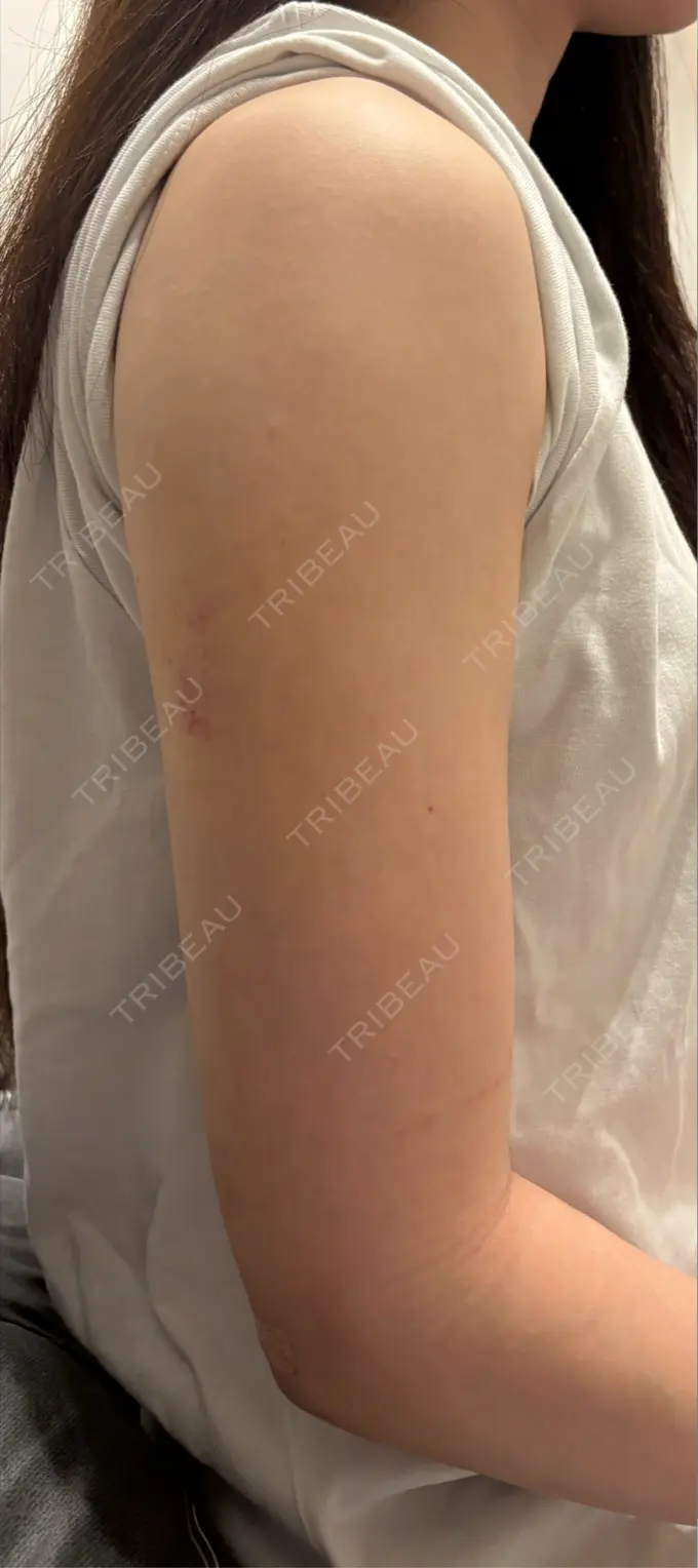 糸リフト / バッカルファット除去 / 脂肪吸引（顔） / 脂肪吸引（二の腕） / ジョールファット除去 / 脂肪吸引（肩） / 脂肪注入（輪郭） First Clinic DAY 14 メイン用