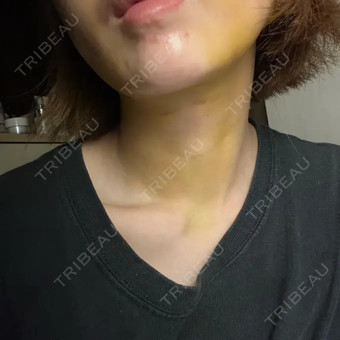 糸リフト / 脂肪吸引（顔） / ジョールファット除去 アリエル美容クリニック 横浜院 DAY 8 メイン用