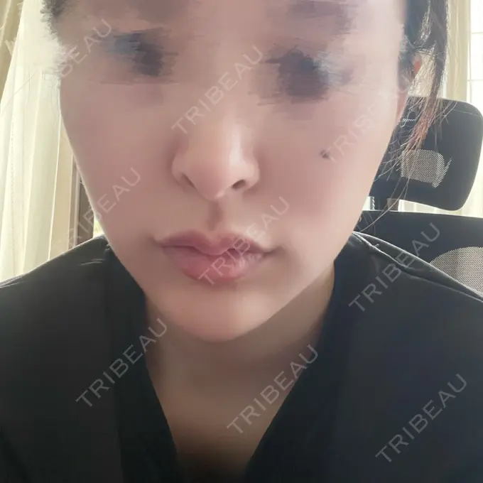 ほくろ・いぼ切除（肌） / ヒアルロン酸注入（あご） NARU Beauty Clinic 【ナルクリ】 水戸院 DAY 1 メイン用