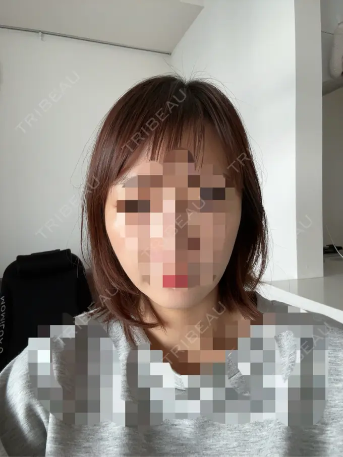 二重埋没 / 糸リフト アリエル美容クリニック 横浜院 AFTER メイン用