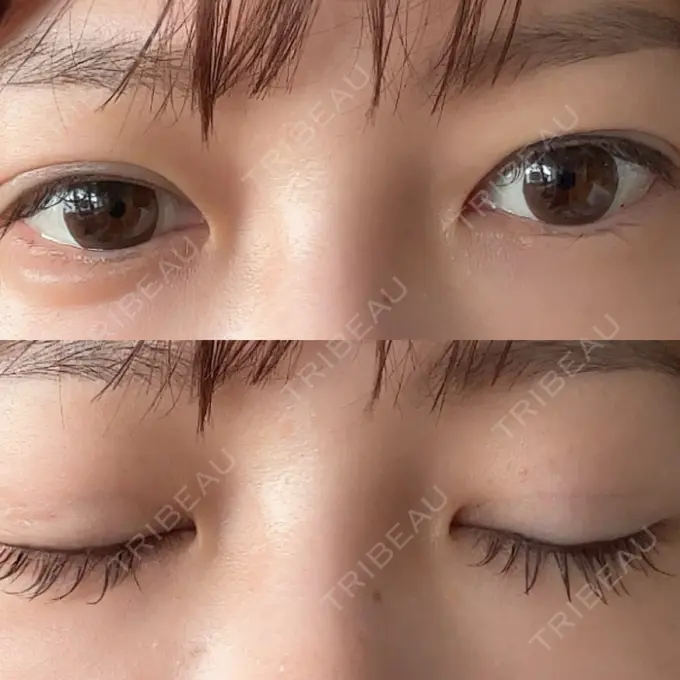 二重埋没 / 糸リフト アリエル美容クリニック 横浜院 DAY 8 メイン用