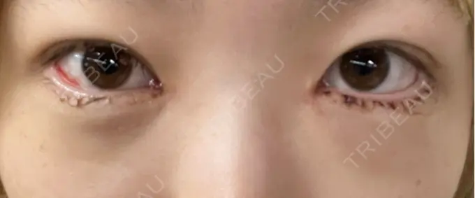 クマ治療 / ヒアルロン酸注入（目の下） BITO BEAUTY CLINIC DAY 6 メイン用