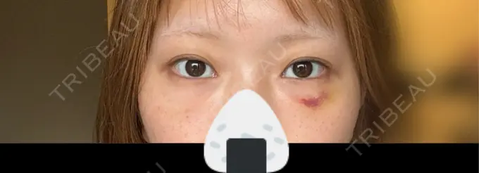 クマ治療 First Clinic AFTER メイン用