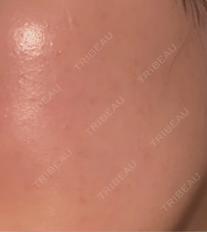 ルメッカ Grias clinic （ジリアスクリニック） AFTER メイン用