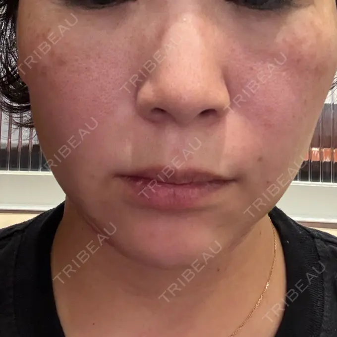 肌ヒアルロン酸注入（たるみ・シワ改善） / 毛穴洗浄（ハイドラフェイシャルなど） / ピコレーザートーニング（美白・肝斑） / その他（輪郭） 東京シルククリニック 東京神田院 AFTER メイン用