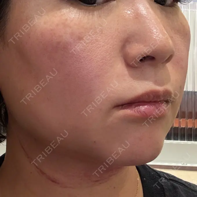 肌ヒアルロン酸注入（たるみ・シワ改善） / 毛穴洗浄（ハイドラフェイシャルなど） / ピコレーザートーニング（美白・肝斑） / その他（輪郭） 東京シルククリニック 東京神田院 DAY 0 メイン用