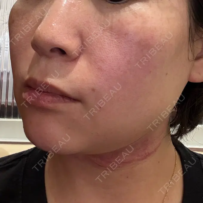 肌ヒアルロン酸注入（たるみ・シワ改善） / 毛穴洗浄（ハイドラフェイシャルなど） / ピコレーザートーニング（美白・肝斑） / その他（輪郭） 東京シルククリニック 東京神田院 DAY 0 メイン用