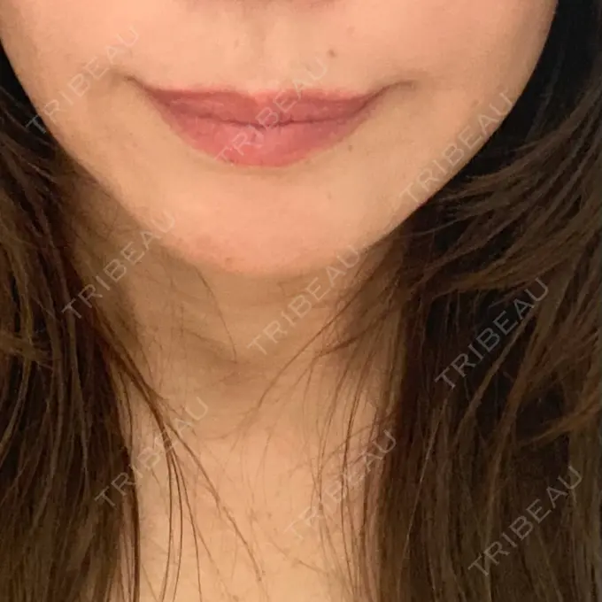 糸リフト / 肌ヒアルロン酸注入（たるみ・シワ改善） アリエル美容クリニック 横浜院 DAY 29 メイン用