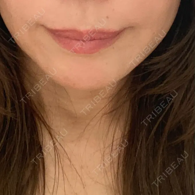 糸リフト / 肌ヒアルロン酸注入（たるみ・シワ改善） アリエル美容クリニック 横浜院 DAY 29 メイン用