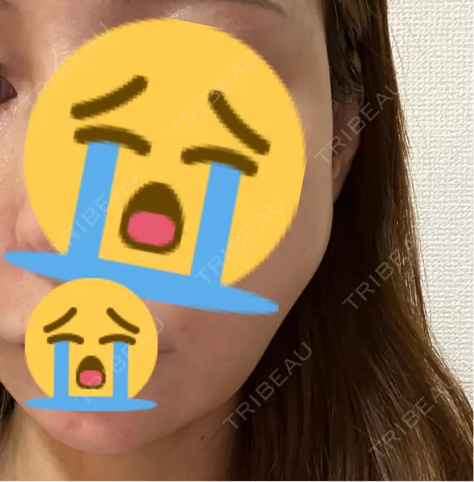 糸リフト MAクリニック 心斎橋 AFTER メイン用