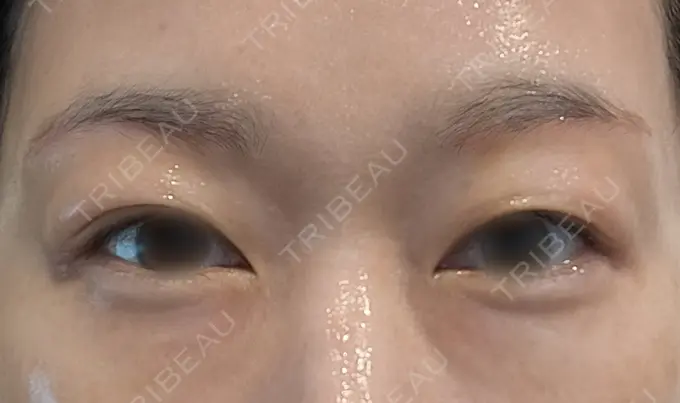 眉下切開 もとび美容外科クリニック 新宿院 DAY 7 メイン用