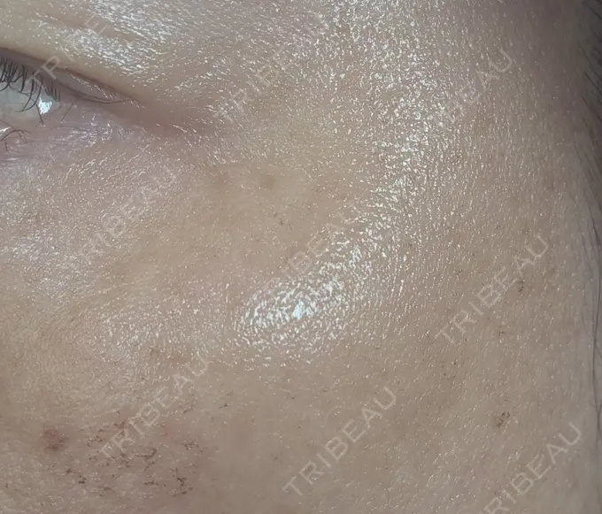 イオン導入 / ピーリング（ハリ・ツヤ） / ルメッカ ルラ美容クリニック 名古屋栄院 / ルラスキンクリニック 名古屋栄院 DAY 5 メイン用