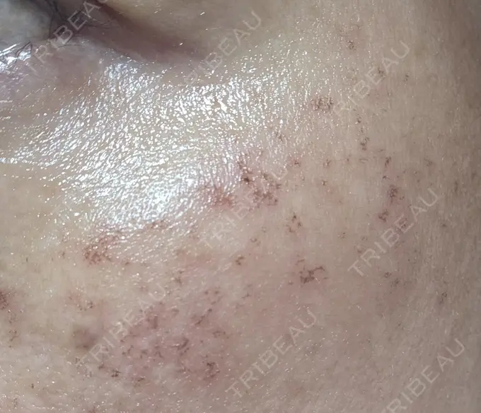 イオン導入 / ピーリング（ハリ・ツヤ） / ルメッカ ルラ美容クリニック 名古屋栄院 / ルラスキンクリニック 名古屋栄院 AFTER メイン用