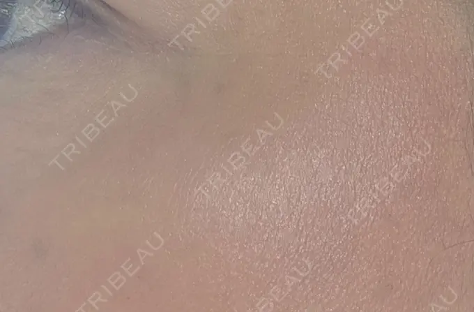 イオン導入 / ピーリング（ハリ・ツヤ） / ルメッカ ルラ美容クリニック 名古屋栄院 / ルラスキンクリニック 名古屋栄院 DAY 5 メイン用