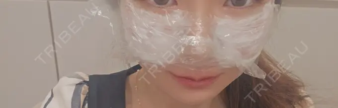 水光注射（ハリ・美肌） Chloe Cheongdam Clinic （クロエチョンダムクリニック） AFTER メイン用