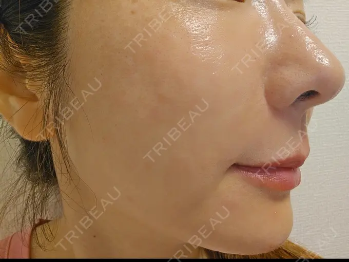 水光注射（ハリ・美肌） Chloe Cheongdam Clinic （クロエチョンダムクリニック） DAY 0 メイン用