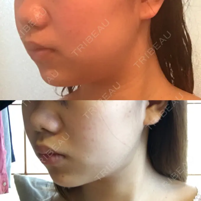 脂肪吸引（顔） みずほクリニック DAY 18 メイン用