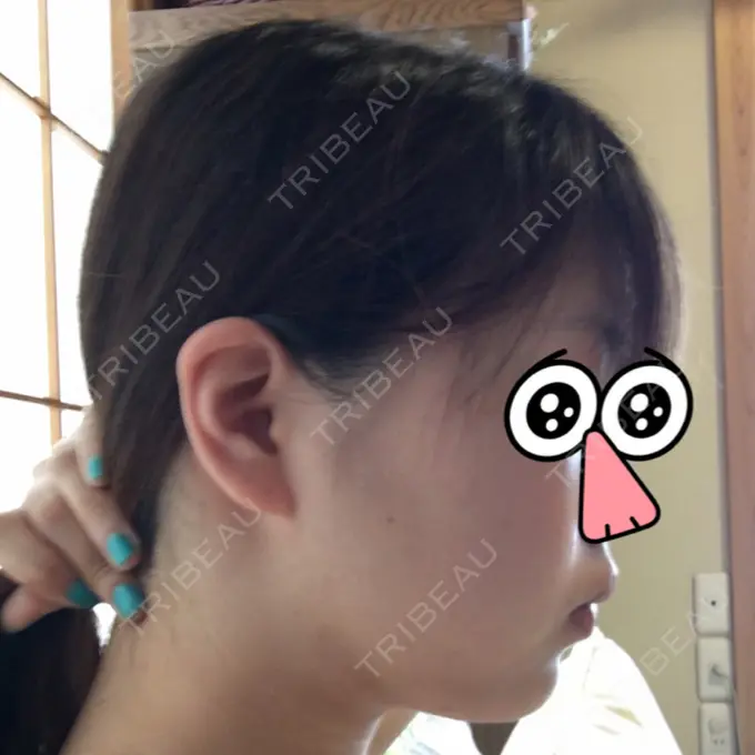 脂肪吸引（顔） みずほクリニック DAY 18 メイン用