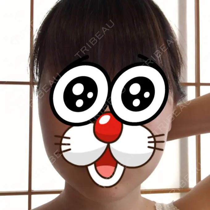 脂肪吸引（顔） みずほクリニック DAY 18 メイン用