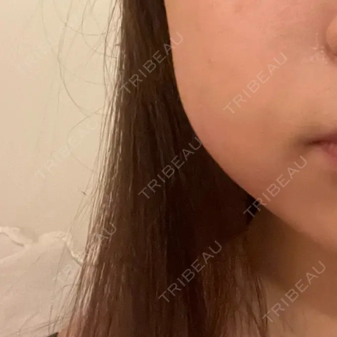 シワ取りボトックス / RF（高周波）たるみ治療 東京シルククリニック 東京神田院 DAY 0 メイン用