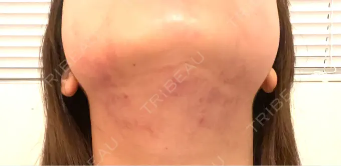 シワ取りボトックス / RF（高周波）たるみ治療 東京シルククリニック 東京神田院 DAY 0 メイン用