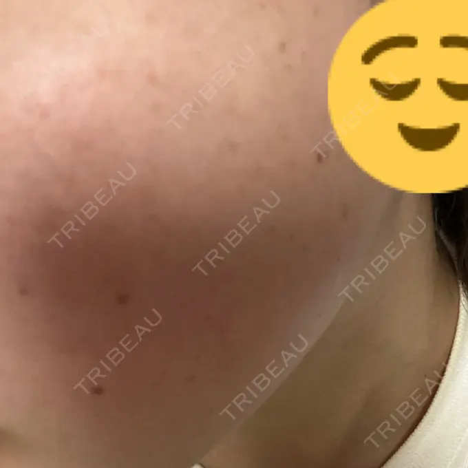 ボトックス（エラ・小顔） 共立美容外科 名古屋院 DAY 6 メイン用